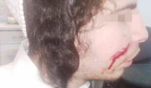В Умані 17-річному брацлавському хасиду порізали обличчя  