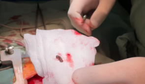Київські лікарі витягли уламок російської міни з серця 4-річної дівчинки