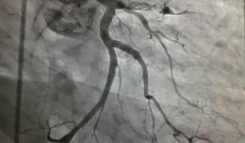 Цьогоріч в Україні діагностували вже більш як 96 тисяч випадків інсульту